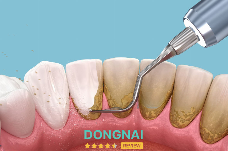 Lựa chọn địa chỉ cạo vôi răng ở Biên Hòa có quy trình khoa học, vô trùng