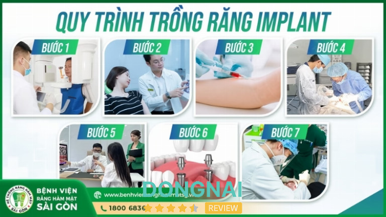 các bước trong quy trình trồng răng Implant tại Bệnh Viện Răng Hàm Mặt Sài Gòn