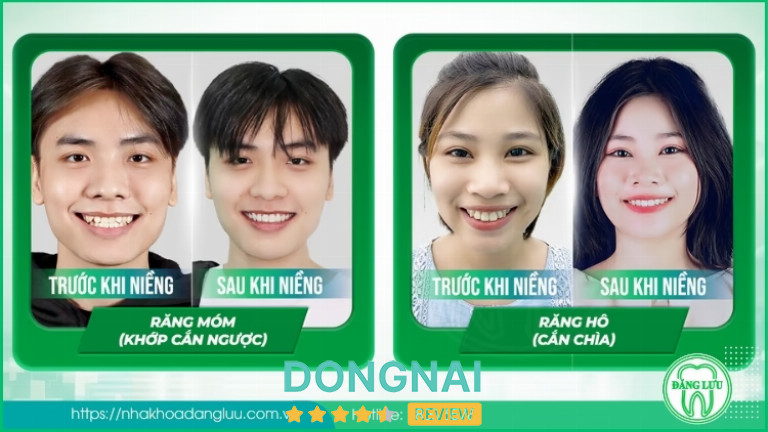 Niềng răng hô, móm tại Nha Khoa Đăng Lưu